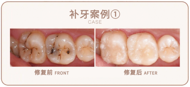 鹏爱口腔19周年庆，洗牙9.9元太香了！