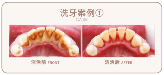 鹏爱口腔19周年庆，洗牙9.9元太香了！